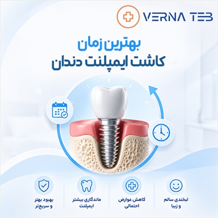 بهترین زمان برای کاشت ایمپلنت دندان