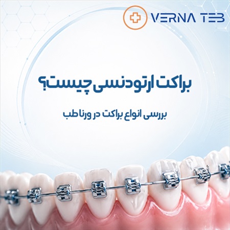 براکت ارتودنسی چیست؟